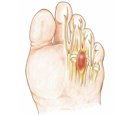 Il Neuroma di Morton